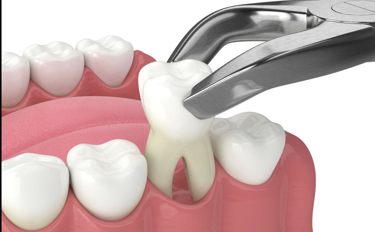 Orthodontic Treatment: Is Tooth Extraction Necessary?