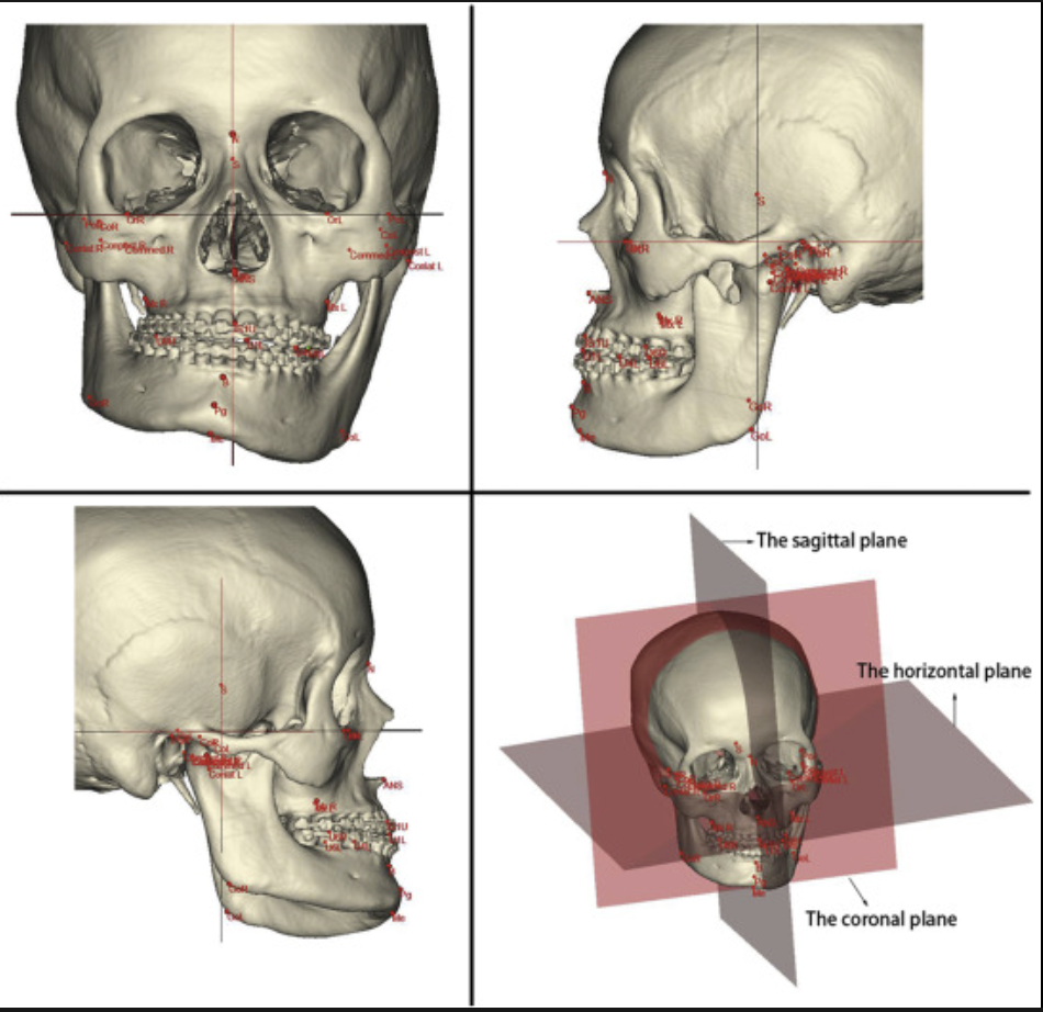 Understanding Hemimandibular Hyperplasia (Jaw Asymmetry): Diagnosis and Nature of the Condition
