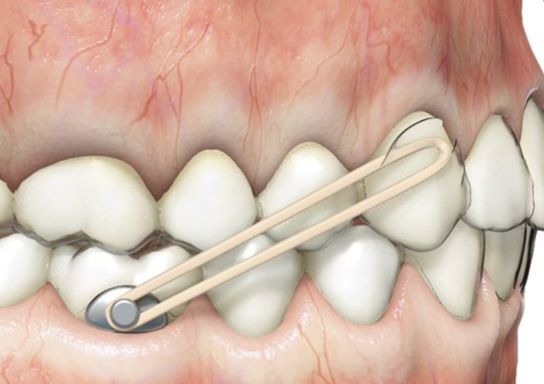 The Application of Elastics in Invisible Orthodontics