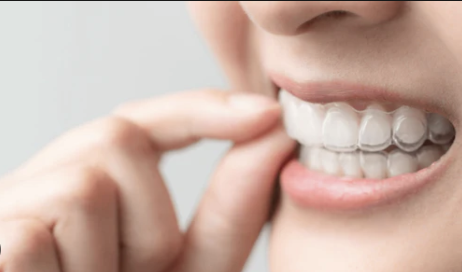 Causes and Solutions for the Misfit of the Attachment Template or the First Set of Aligners