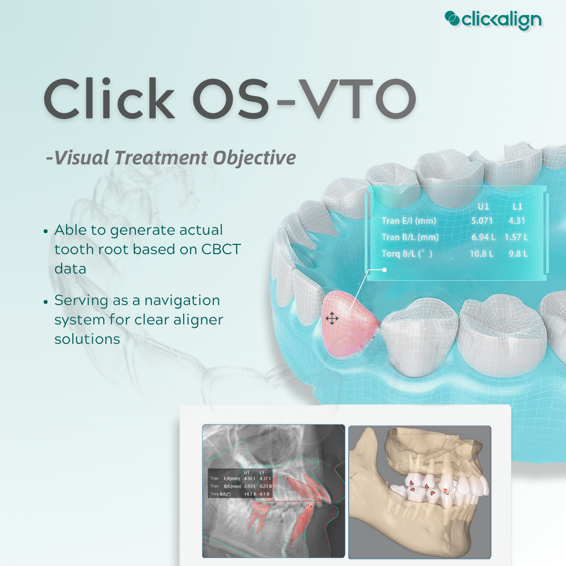 Click OS 2.0: VTO Root System ---'BeiDou Navigation Satellite System’ in Invisible Orthodontic Treatment