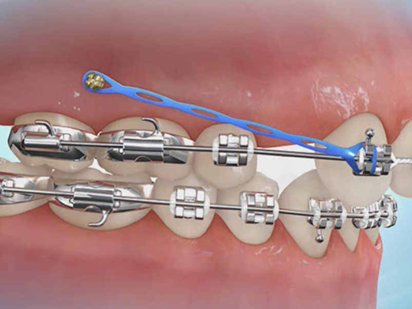 Is a Bone Screw Necessary in Orthodontic Treatment? Does it Hurt?