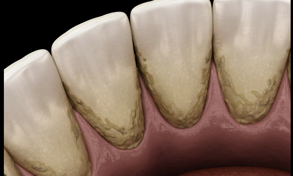 Understanding Dental Calculus (Tartar) and its Impact on Oral Health