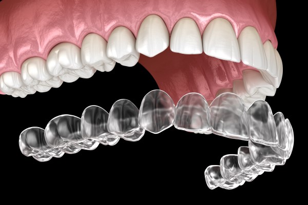 What is the best material for clear aligners?