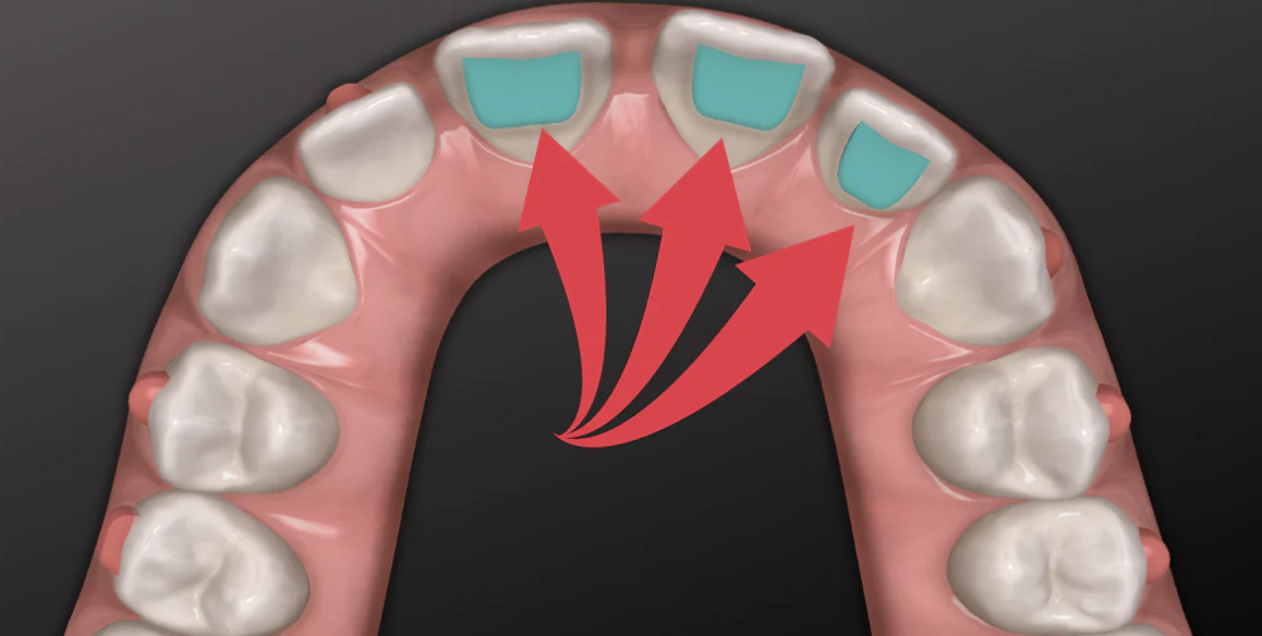 Bite Turbos in Invisible Orthodontics: A Comprehensive Guide Introduction