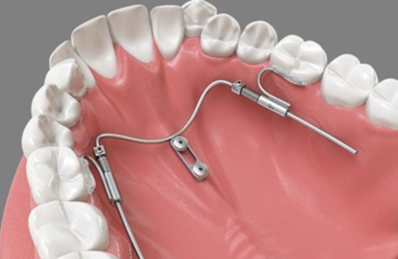 Achieving Balance and Harmony: Molar Distalization in Invisible Orthodontics