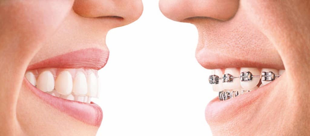 Clear-aligners-vs-Traditional-Braces